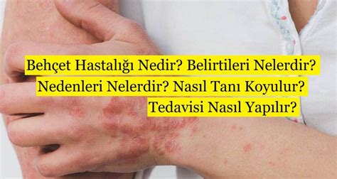 Beh Et Hastal Nedir Belirtileri Nelerdir Nedenleri Nelerdir Nas L