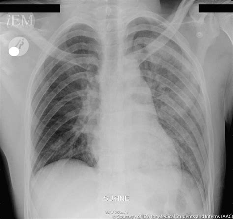 Apical Pneumothorax Chest X Ray