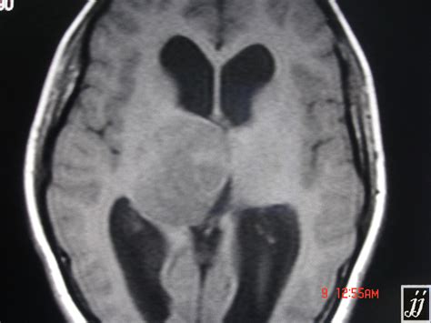 astrocytoma – Radiopaedia