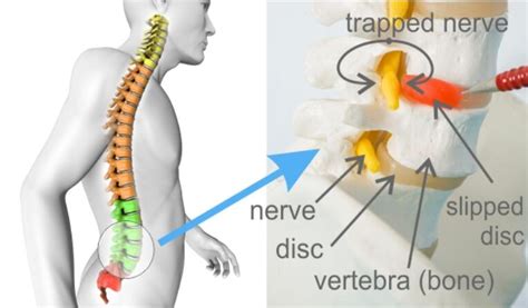 Pins and Needles in Hands:15 Causes with Treatment