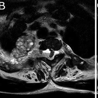 Sagittal A And Axial B And C T Weighted Mri Thoracic Stenosis At