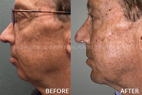 Chin Implant Facial Plastic Surgery Center Washington University In