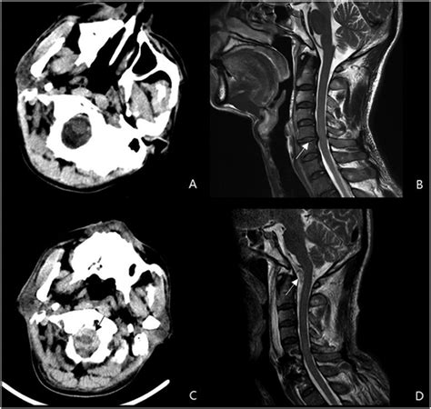 Preoperative Magnetic Resonance Imaging Mri And Computed Tomography