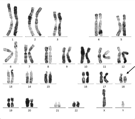 Délétion Du Bras Court Dun Chromosome 18 Monosomie 18p Chez Un Download Scientific Diagram