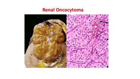 Pathology of Renal Oncocytoma - Pathology Made Simple