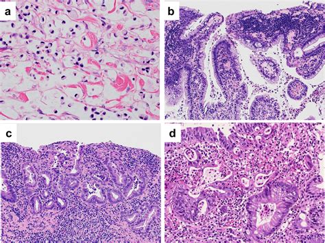 Histopathological Diagnosis Of Ulcerative Colitisassociated Neoplasia