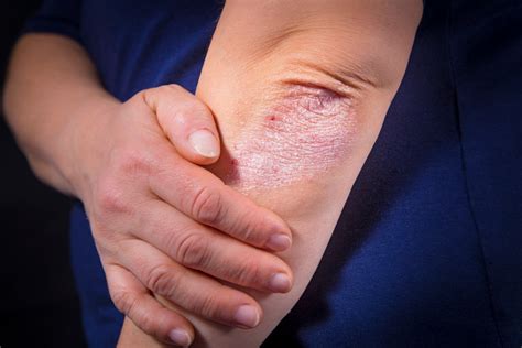 Dealing With Eczema Dupixent May Be The Solution Youve Been Searching