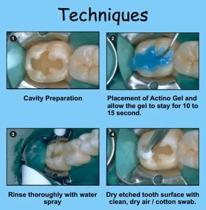 Prevest Actino Gel Liquid Alpha Dentkart