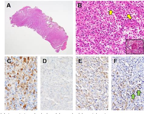 Figure 3 From Gingival Juvenile Xanthogranuloma Semantic Scholar