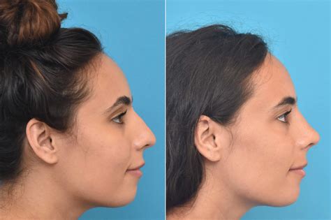 Rhinoplasty Photos Philadelphia Pa Patient 3763