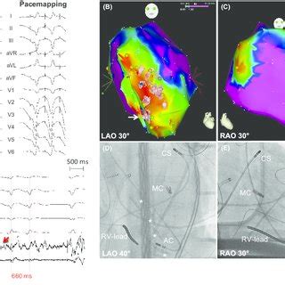 Ablation Of VT1 A B Electroanatomical Maps Points I Red II