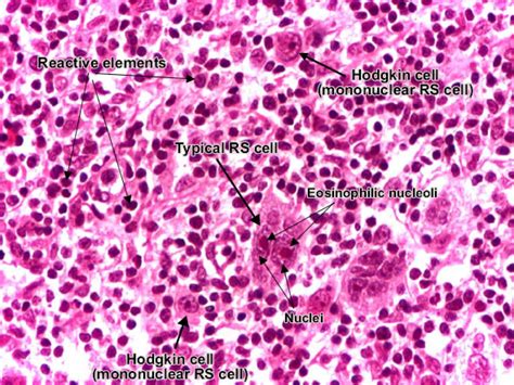 Reed-Sternberg Cells