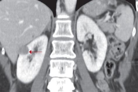 Renal Cell Carcinoma