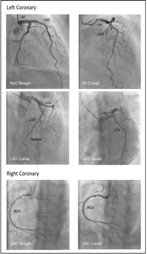 Angiograf A De Arterias Coronarias Wfsa Resources