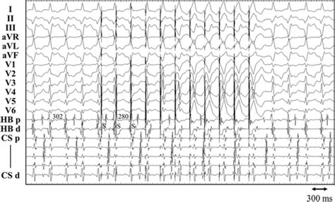 Multifocal Ventricular Arrhythmias Originating From The His Purkinje