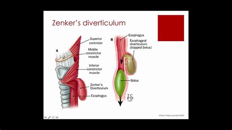 E207 Preview Gerd And Lpr In Adults The Slps Role In Diagnosis