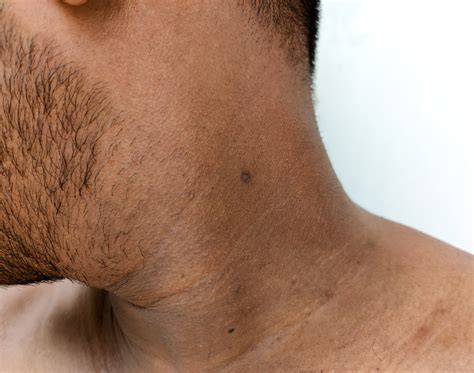 Treatment Of Horizontal Neck Lines Mclean Potomac Dermatology