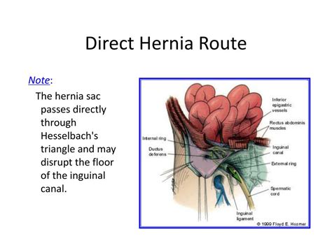 Ppt Hernias And Intraperitoneal Abscess Powerpoint Presentation