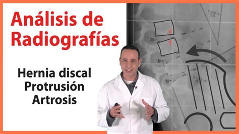 Pilates Para Hernia Y Protrusi N Discal C Mo Aliviar El Dolor Y