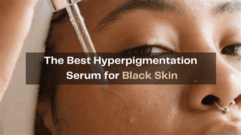 Best Serum For Hyperpigmentation For Black Skin Bianca Miller London