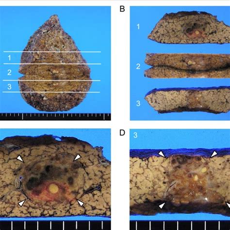 Gross Appearance Of Surgically Resected Specimen The Resected Specimen