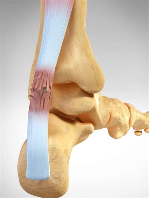 Dr Ferran Abat Cual Es La Diferencia Entre Tendinitis Y Tendinosis