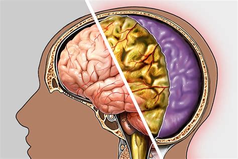 Visual Guide To Meningitis