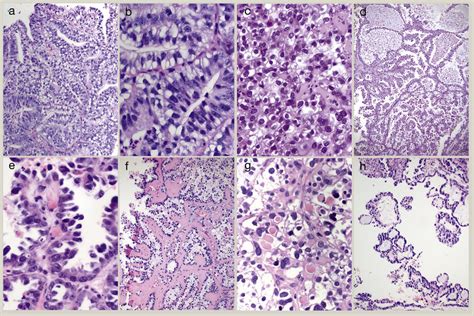 Clear Cell Rich Cancers Endometrioid Carcinoma With Clear Cytoplasm