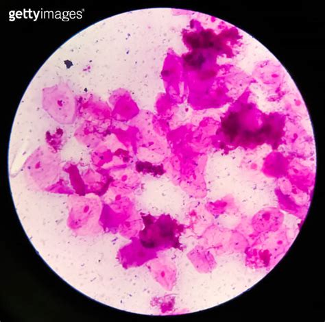 Prostatic Smear P S Gram Stain Microscopic X Show Few Pus Cells