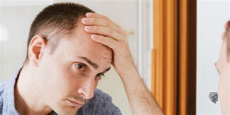 How To Stop Male Pattern Baldness Ahs India