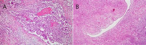 Hematoxylin And Eosin Staining Of The Resected Specimen Showing A