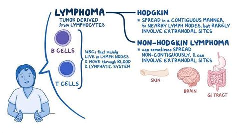 Hodgkins Lympnoma Medizzy