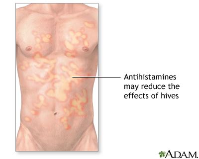 Hives | UF Health, University of Florida Health