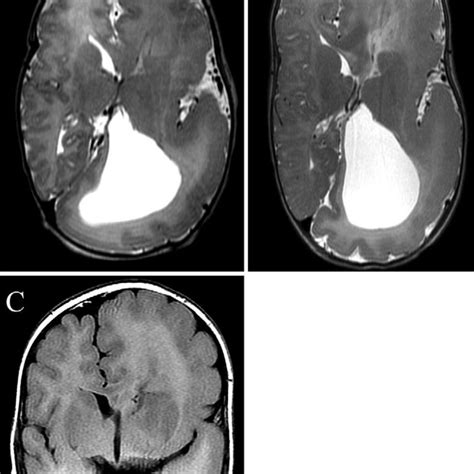 One Month Axial T2 Weighted A 6 Month Axial T2 Weighted B And