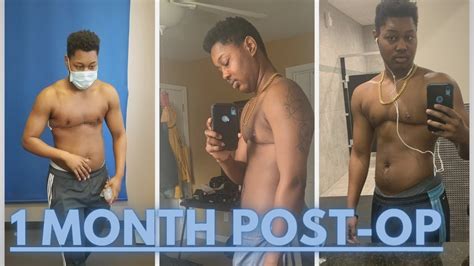 1 Month Post Op Top Surgery Double Incision Ftm Dr Mosser Top Surgery Recovery Scar