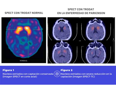 QUÉ HAY DETRÁS DEL DIAGNÓSTICO DE LA ENFERMEDAD DE PARKINSON