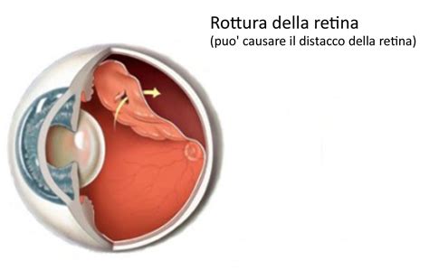 Malattie Delle Retina Degenerazione Maculare Rimedi Lombardi Eye Clinic