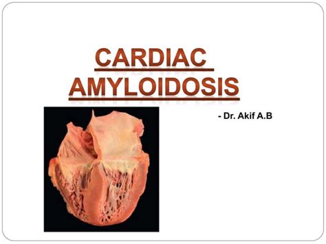 Cardiac Amyloidosis Dr Akif Ppt