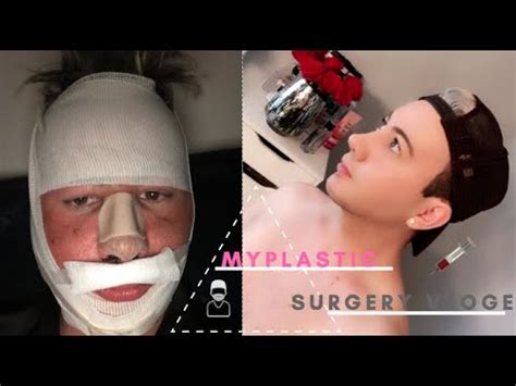 My Plastic Surgery Vlog Youtube