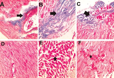 Representative Masson S Trichrome Stained Sections Of Heart Shows A