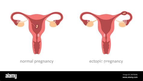 la salud de la mujer normal y el embarazo ectópico embrión Imagen