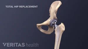 Surgery for Hip Osteoarthritis | Arthritis-health