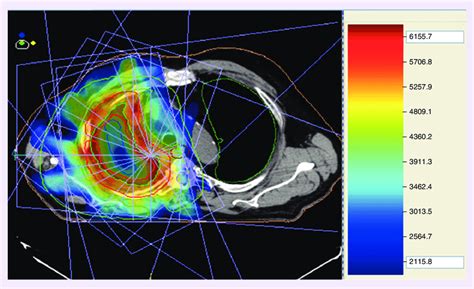 Radiation Therapy Treatment Planning - All About Radiation