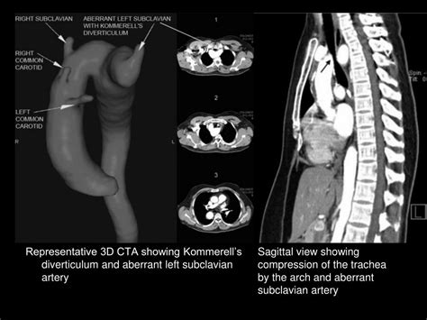 Ppt Kommerell’s Diverticulum Repair With A Right Sided Aortic Arch Strategies And Techniques