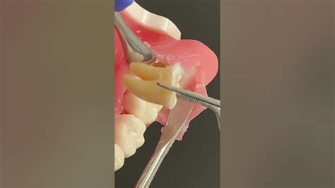 Removal Of Horizontal Impacted Wisdom Teeth Youtube