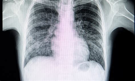 Ofev Nintedanib Approved By Fda To Treat Interstitial Lung Diseases