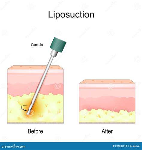 Procedimento De Lipoaspira O Ilustra O Do Vetor Ilustra O De Fino