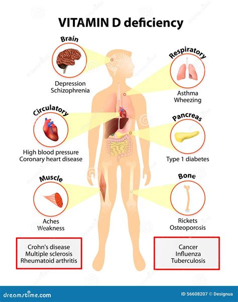 Vitamin D Deficiency Symptoms And Diseases Stock Vector Image 56608207