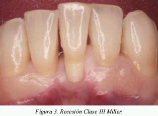 T Cnicas De Cirug A Mucogingival Para El Cubrimiento Radicular