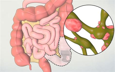 Patient Learning Abdominoperineal Resection Tvasurg The Toronto